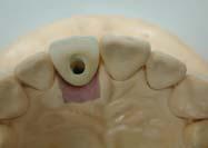 5mm you can fabricate a screw retained type prosthesis using zirconium exclusive porcelain.