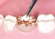complete the occlusal surface with resin. Short long 1.