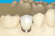 access hole with occlusal material