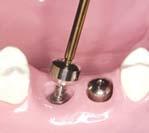 Upper Posterior 5 : platform 6 : Wide screwed bridge Esthetic-low abutment Step1 Removing the Cover screw or Healing abutment Components & instruments Step2 Connecting the Esthetic-low