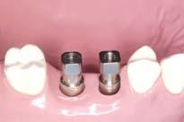 Esthetic-low abutment Step3 Connecting the impression