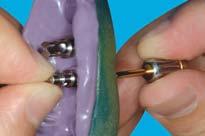 Esthetic Gold Cylinder Prosthetic Procedure