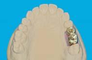 screw-type implant gold bridge in the
