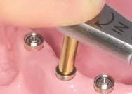 Prepare an esthetic low abutment considering the gingival depth and space with antagonist teeth.