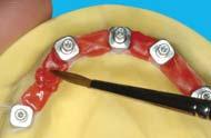 gingiva; to compensate the resin shrinkage,