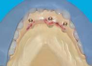 between the final model and intraoral environment) Registering the putty