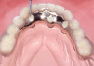 access hole with occlusal material intraorally as a final step