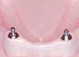 The shoulder of the abutment must be positioned above the tissue (about 1.5~2 mm). Using a O-ring abutment driver, connect the abutment to the implant.