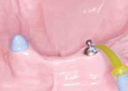 procedure : Before mounting the abutment, take a full-mouth