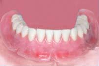 Resend the wax denture to the clinic to have the occlusion on the arranged teeth checked and the