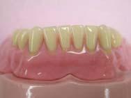 While connecting the attachments, instruct the patient on oral hygiene and precautions during the attachment and detachment of the denture.
