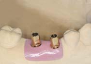 Cement abutment Cement abutments Step4 Wax up 4.