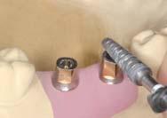 Fasten the Cement abutment to the analog with a screw using