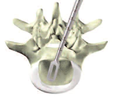 4 Remove intervertebral disc and prepare endplates Required instruments Bone Curette, rectangular, straight, 8 mm 389.