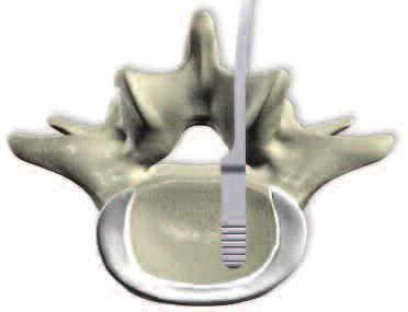 6b Distraction using a distractor Required instruments Plivios Distractor 389.101 Place the distractor blades in the intervertebral disc space laterally to the epidural space.
