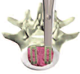 10 Insert implant Insert the cage horizontally into the intervertebral disc space by gentle impaction. Protect the nerve roots and dura with a suitable instrument.