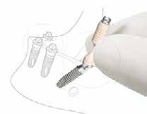 Xive S The SmartFix concept Prosthetic solution on angled implants The SmartFix concept is an efficient and time-saving immediate loading treatment on four implants for screw-retained restorations.
