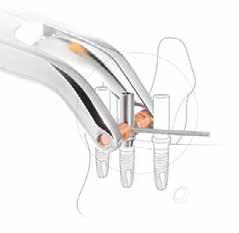 The WeldOne concept Temporary restorations on implant level With the help of the WeldOne Welding Unit and special welding components, a titanium wire is permanently connected to the abutment with