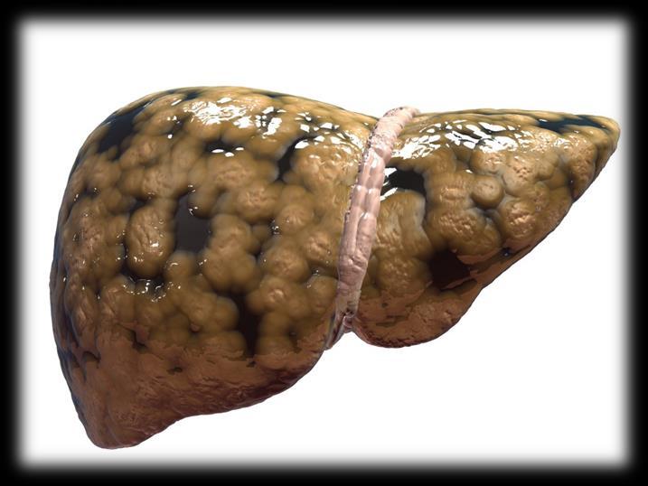 NAFLD Definition Evidence of hepatic steatosis (imaging or histology) and lack of secondary causes of fat accumulation (alcohol,