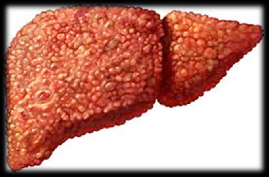 Indicators for liver failure Liver decompensation Sequelae of portal