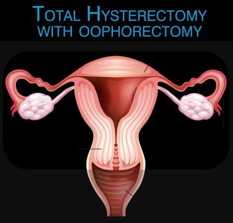 HRT regimens after RRSO: No uterus Unopposed estrogen Probably no increased risk of