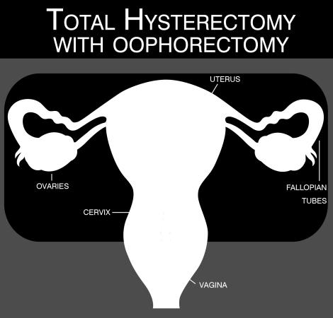 Concomitant hysterectomy at the time of RRSO to be able to give unopposed estrogen?