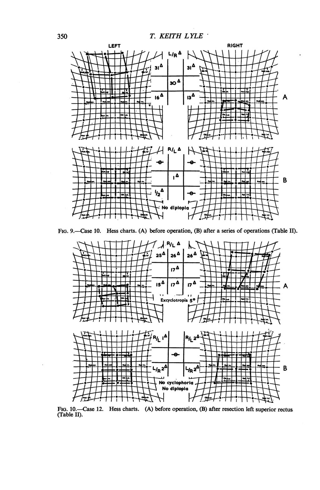 350 FIG. 9.-Case 10. zt~~ r1~~ I T. KEITH LYLE Hess charts. (A) before operation, (B) after a series of operations (Table II).
