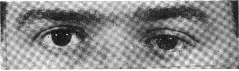 5.-Case 4. Displacement of left eyeball with constant vertical diplopia.