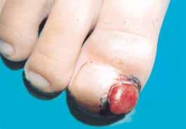 Fig. 1 A 1.5 cm mildly tender erythematous nodule on the periungual area of the right big toe that had been slowly enlarging for about one month. Fig.