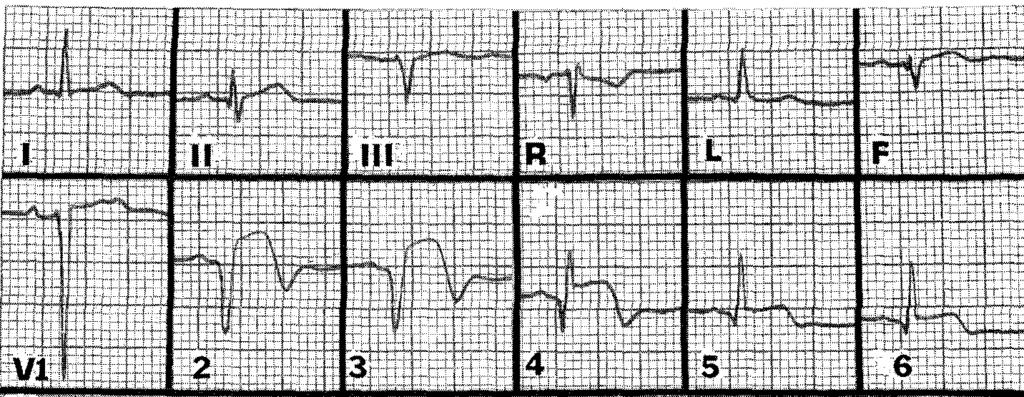 Phenylephrine Propranolol Vasopressin a. Increased heart rate b. Decreased heart rate c. Increased preload d. Decreased preload e. Increased afterload f. Decreased afterload g.