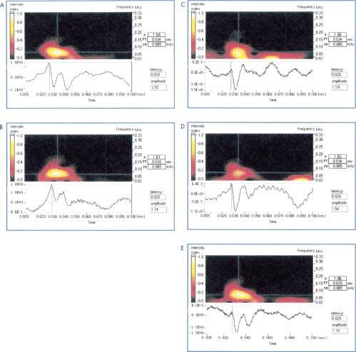 Time frequency analysis in intraoperative spinal cord monitoring 85 Figure 2 A sample of somatosensory evoked potentials (SEP) from Cv-Fz in a series of plots recorded at different stages of surgery: