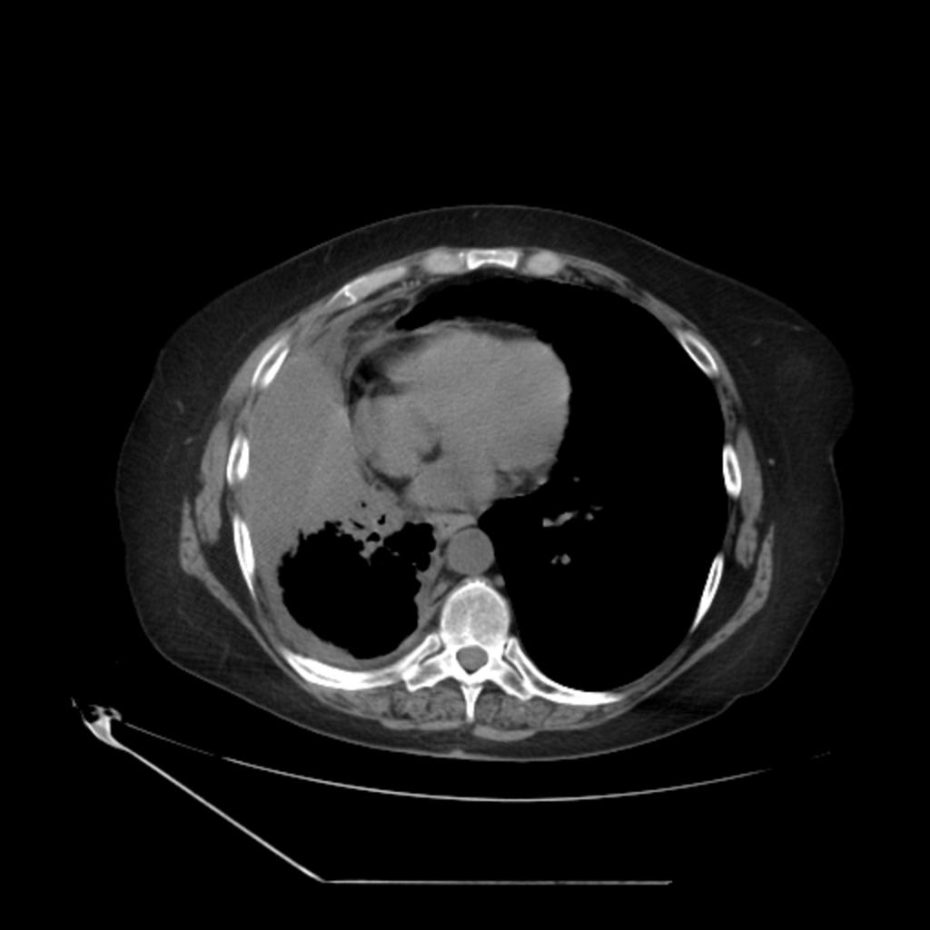 Fig. 5: Free pleural effusion on CT (sickle-shaped or crescentic shape) References: - Lisboa/PT Loculated effusions: Lenticular shape with smooth
