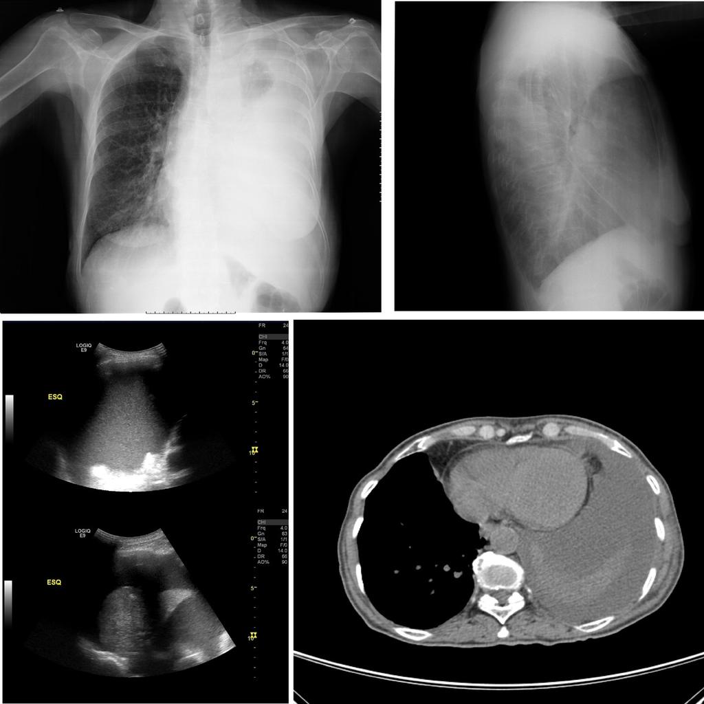 Images for this section: Fig. 8: Large pleural effusion that was homogeneously echogenic on US.