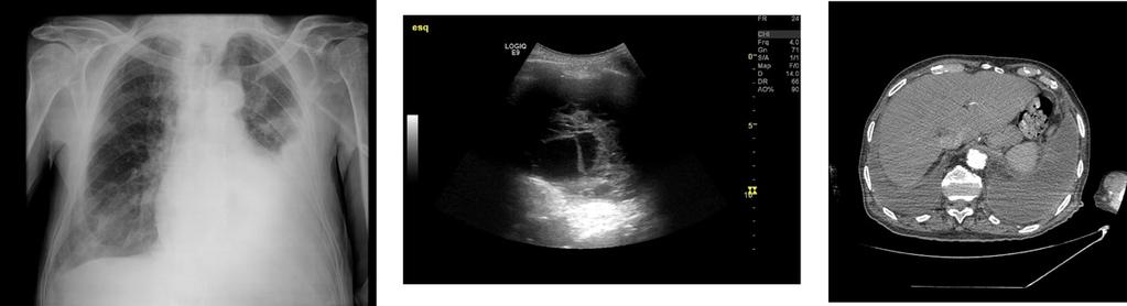 Fig. 9: X-ray and CT showing a moderate left pleural effusion.