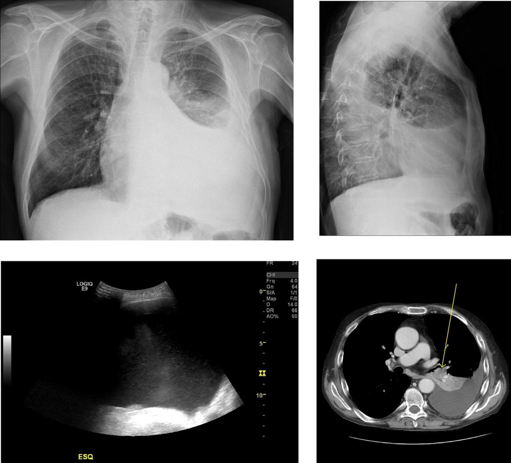 - Lisboa/PT Fig. 11: Imaging evaluation of a pleural effusion: CT shows a central mass occluding left lower lobar bronchus with atelectasis of left lower lobe.