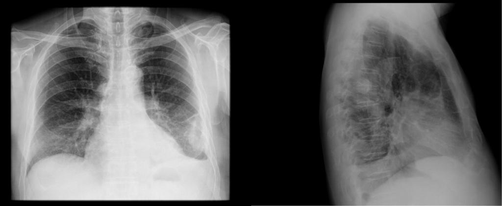 Findings and procedure details Chest Radiograph: It is usually the first imaging approach regarding a pleural effusion.