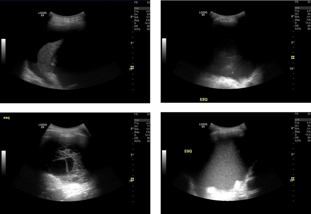 Fig. 4: Different aspects of pleural effusion: anechoic/free (upper left image), complex non septated (upper right), complex septated (lower left) and homogeneously echogenic (lower right).