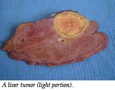 Liver Cancer (Hepatocellular Carcinoma or HCC) Overview Recent advances in liver cancer care seek to address the rising incidence of liver cancer, which has steadily increased over the past three
