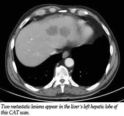 The liver is the most common site for metastasis from gastrointestinal cancers, such as colon cancer or pancreatic cancer.