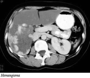 Overview of Non-Cancerous Liver Lesions Masses within the liver are increasingly being detected inadvertently when patients are evaluated for unrelated reasons.