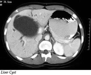 A simple liver cyst is usually a single cyst located within the liver, which is present from birth. Most cysts are asymptomatic and are uncommonly diagnosed before age 40.