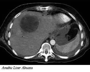 Infectious Cystic Masses Pyogenic Liver Abscesses (bacterial cause) - There are numerous causes of bacterial infections that bring about abscess formation in the liver.