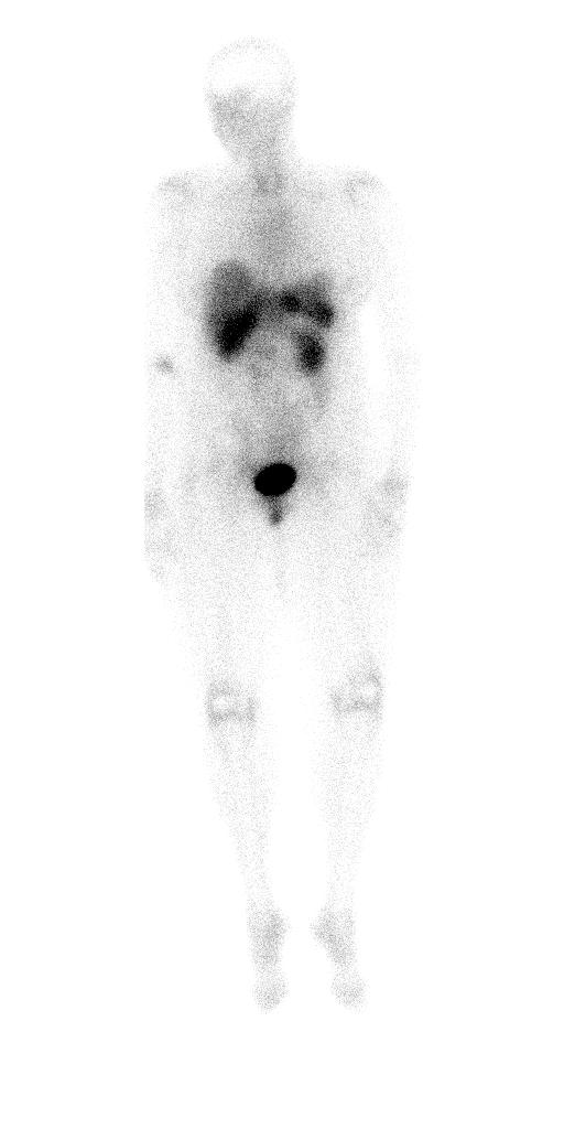 Octreotide Scan Two adjacent tubular foci of mild radiotracer uptake in the central abdomen