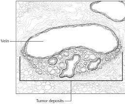 Definition Tumor Deposits Separate tumor nodules or tumor deposits of malignant cells in perirectal or pericolic fat with no evidence of lymph node tissue Found in primary lymphatic drainage area