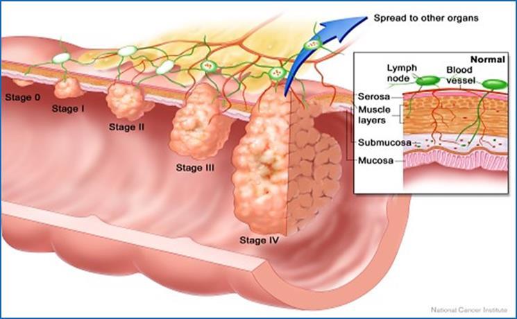 Colon and Rectal Cancer Staging 47 Source: National Cancer Institute Staging Parameters Clinical (Pre-Tx) Stage is Critical for Rectal Cancers Primary Tumor Grade Important for NET/GIST Typical