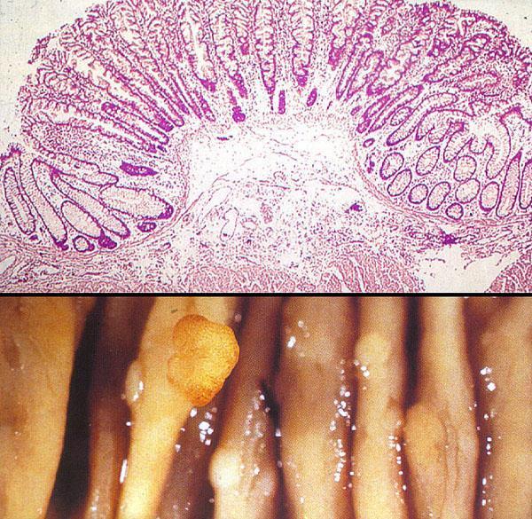 org Polyps and Colon Cancer 14 HYPERPLASTIC POLYP NO