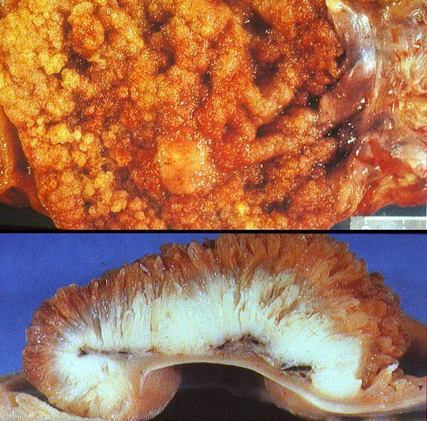 Polyps and Colon Cancer 17 SESSILE VILLOUS and TUBULO- VILLOUS ADENOMA