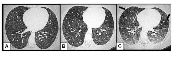 HRCT in subacute HP (A) 40-year-old woman exposed to birds, numerous ill-defined nodules.