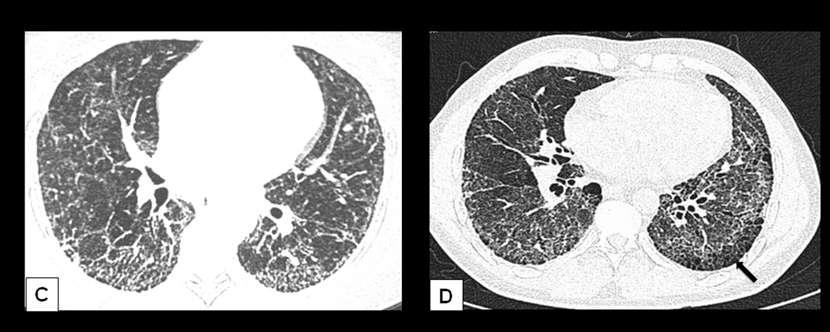 (C) Subpleural predominant distribution of scattered nodules, ground-glass and reticular opacities, and traction bronchiectasis.