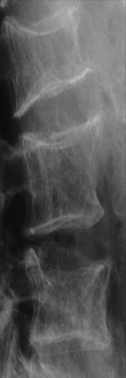 Qualitative Assessment Gold standard is qualitative: Visual diagnosis lateral spine radiograph Dependent on good radiographic techniques This gives fracture: